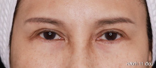 Lower Eyelid Surgery