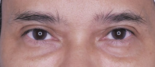 Lower Eyelid Surgery