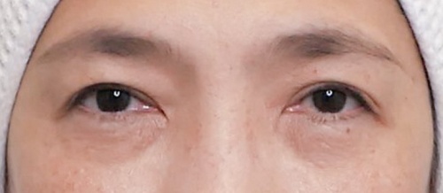 Lower Eyelid Surgery