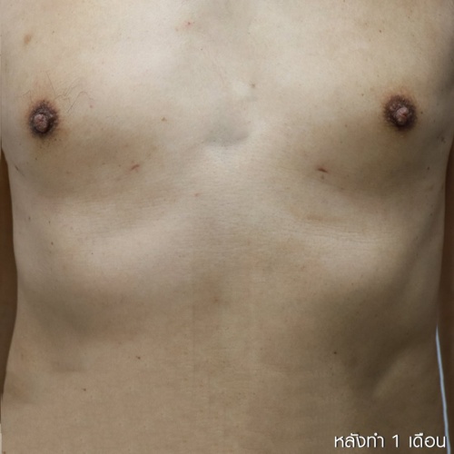 ลดขนาดหน้าอกผู้ชาย