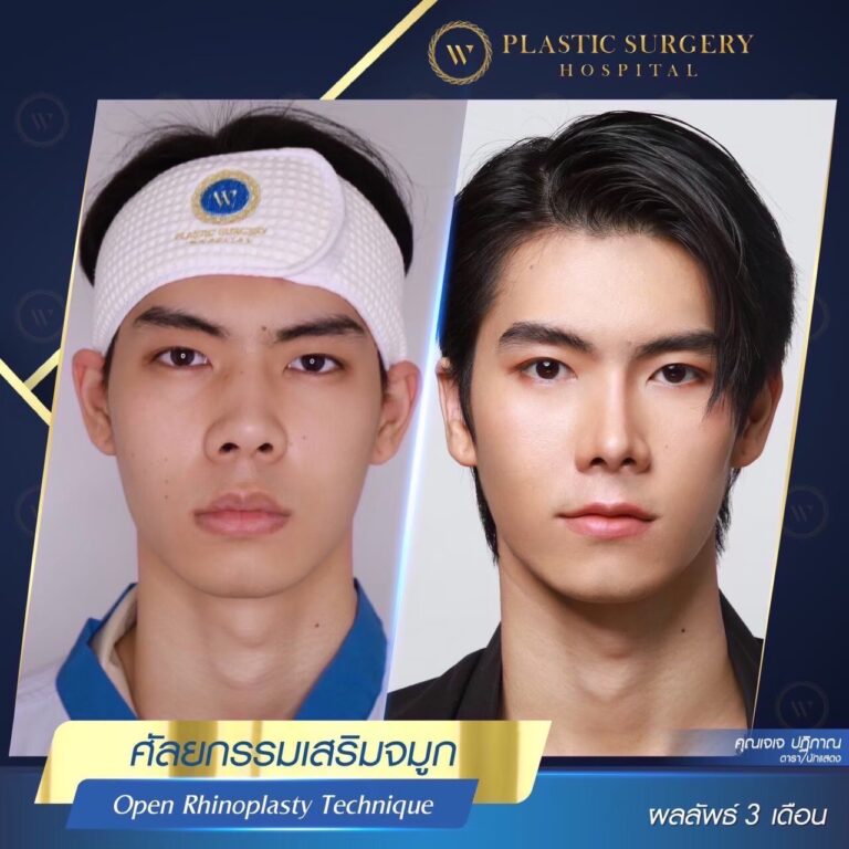 LINE_ALBUM_ศัลยกรรมเสริมจมูก_260624_47