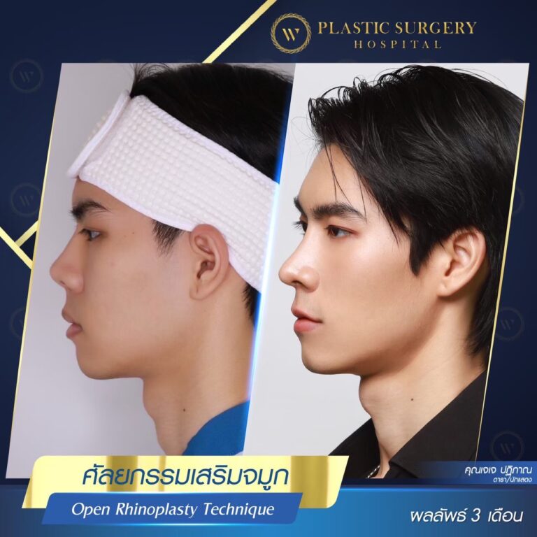 LINE_ALBUM_ศัลยกรรมเสริมจมูก_260624_49